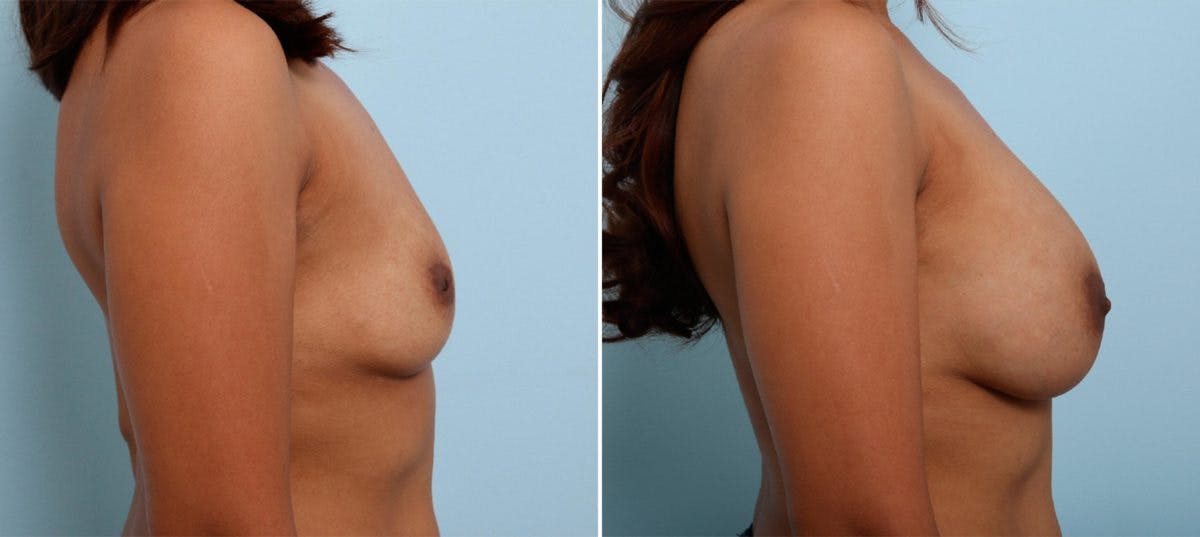Breast Augmentation Before & After Photo - Patient 54887232 - Image 3