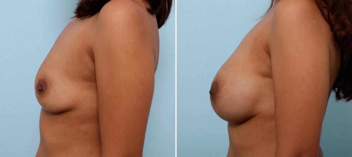 Breast Augmentation Before & After Gallery - Patient 54887232 - Image 5