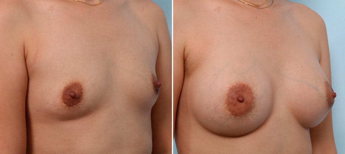 Breast Augmentation Before & After Gallery - Patient 54887233 - Image 2