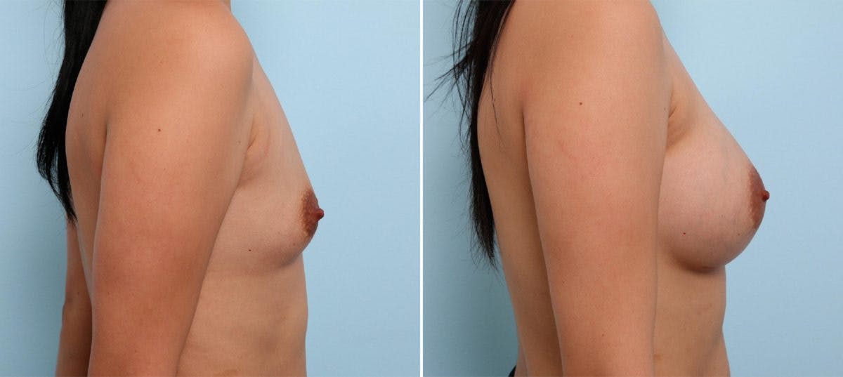 Breast Augmentation Before & After Gallery - Patient 54887233 - Image 3