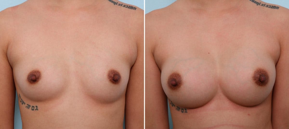 Breast Augmentation Before & After Gallery - Patient 54887237 - Image 1