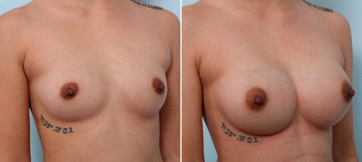Breast Augmentation Before & After Gallery - Patient 54887237 - Image 2