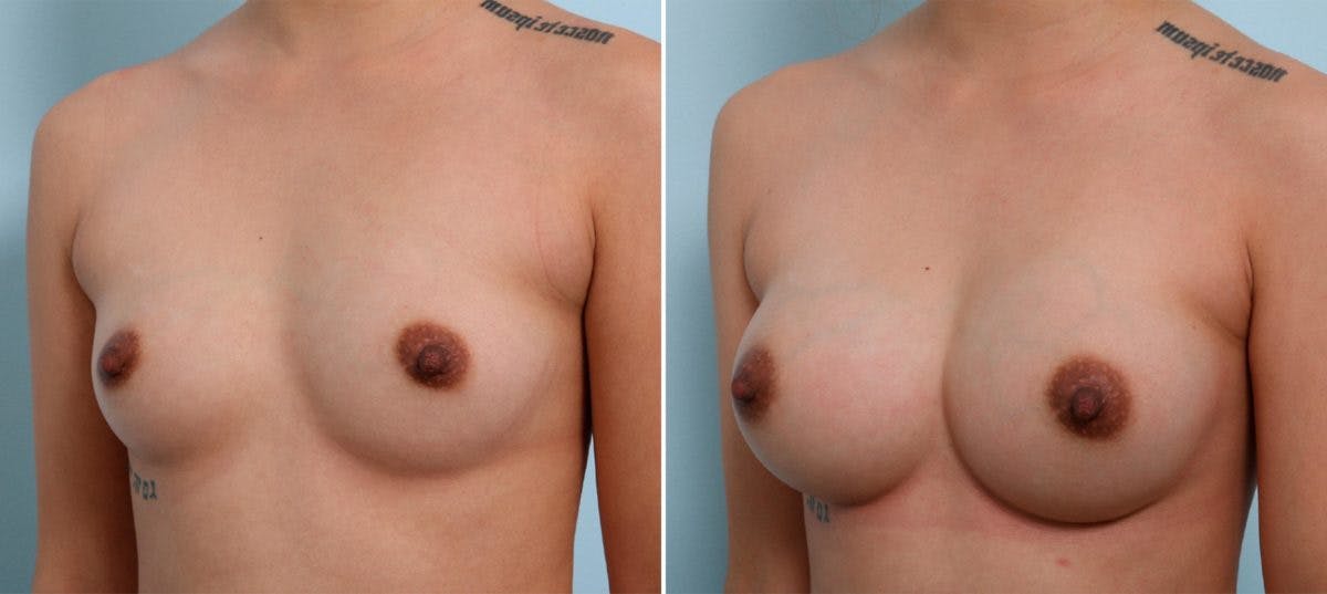 Breast Augmentation Before & After Gallery - Patient 54887237 - Image 4