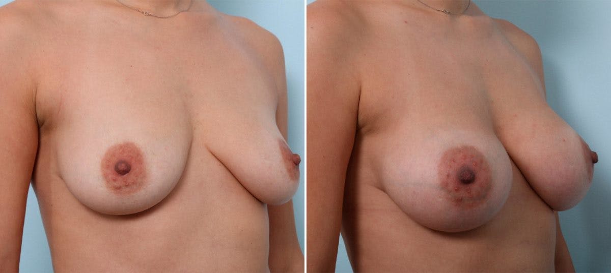 Breast Augmentation Before & After Gallery - Patient 54887240 - Image 2
