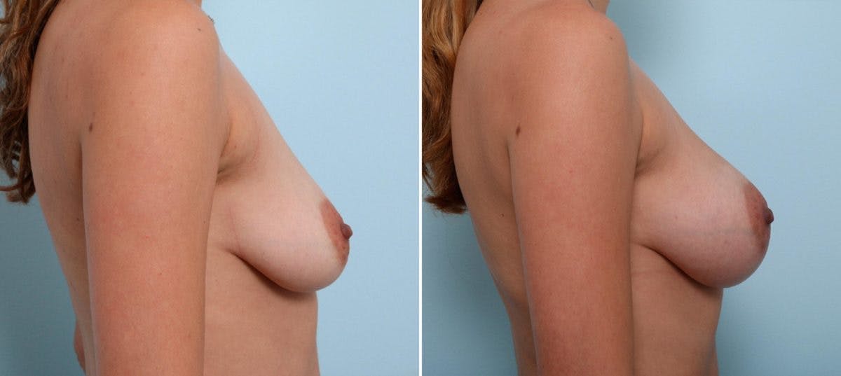 Breast Augmentation Before & After Gallery - Patient 54887240 - Image 3