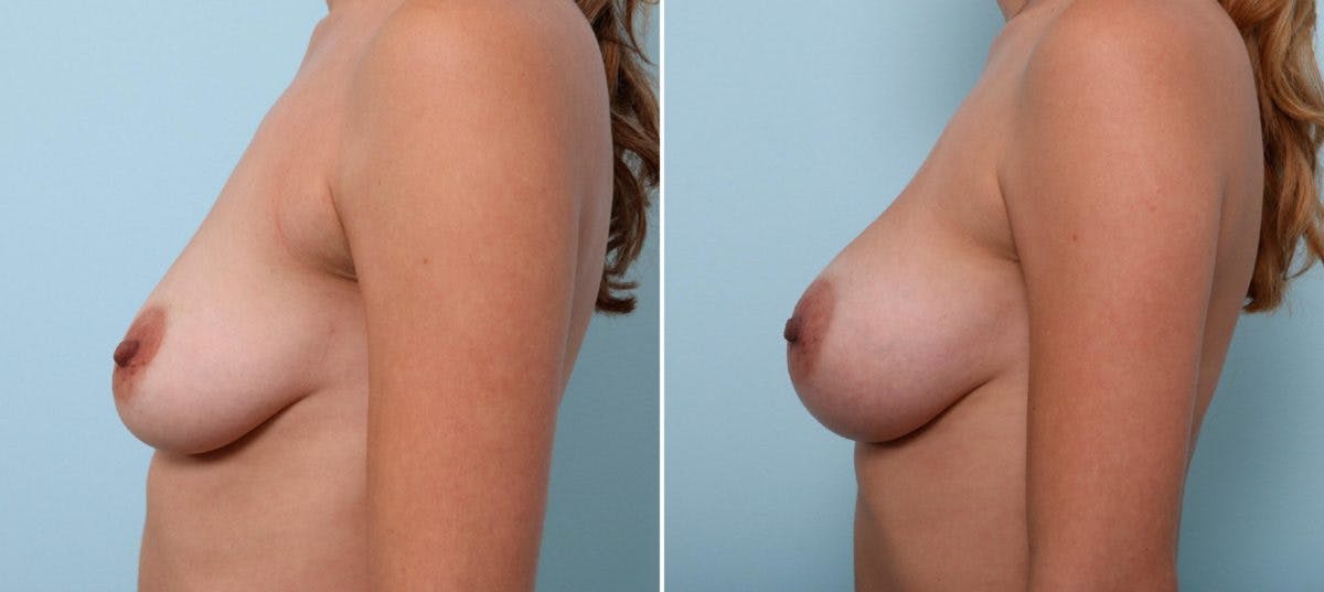 Breast Augmentation Before & After Gallery - Patient 54887240 - Image 4