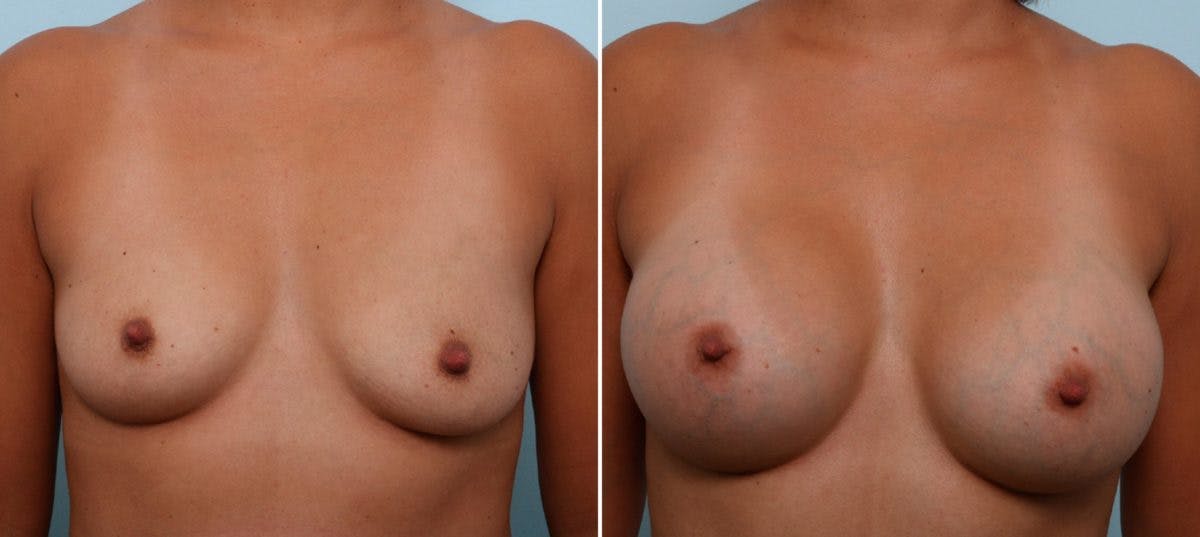 Breast Augmentation Before & After Photo - Patient 54887243 - Image 1