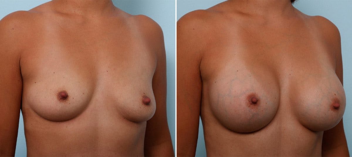 Breast Augmentation Before & After Photo - Patient 54887243 - Image 2