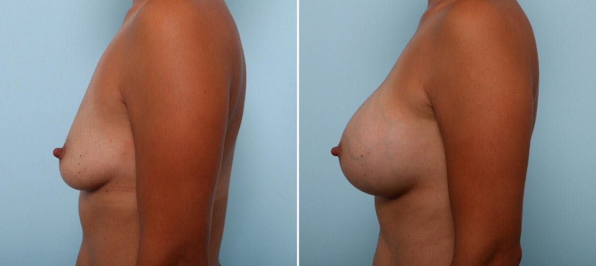 Breast Augmentation Before & After Gallery - Patient 54887243 - Image 5