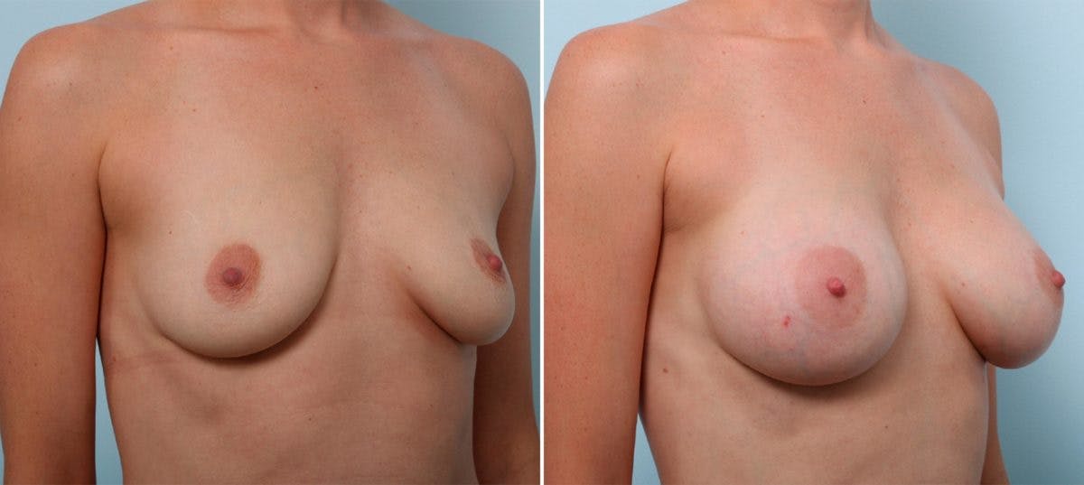 Breast Augmentation Before & After Gallery - Patient 54887245 - Image 2