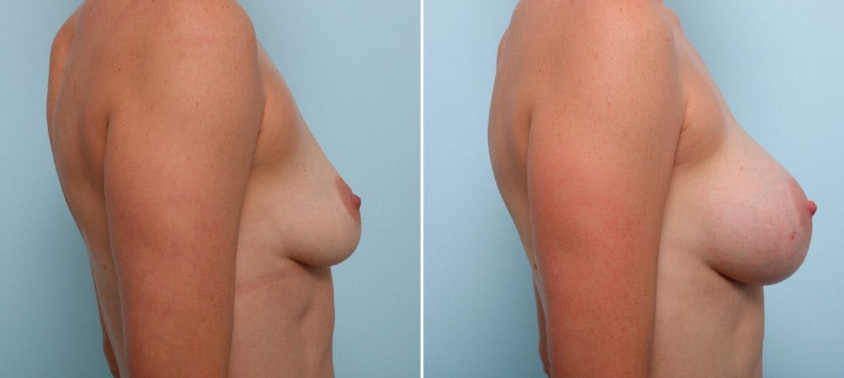 Breast Augmentation Before & After Gallery - Patient 54887245 - Image 3