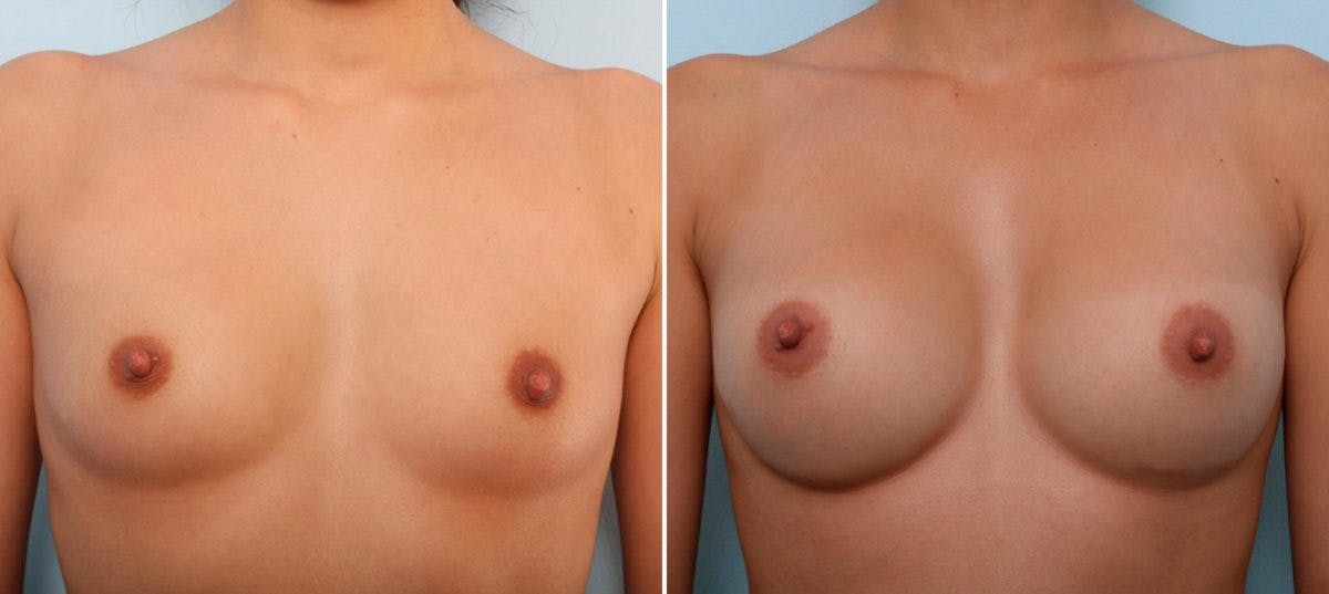Breast Augmentation Before & After Gallery - Patient 54887247 - Image 1