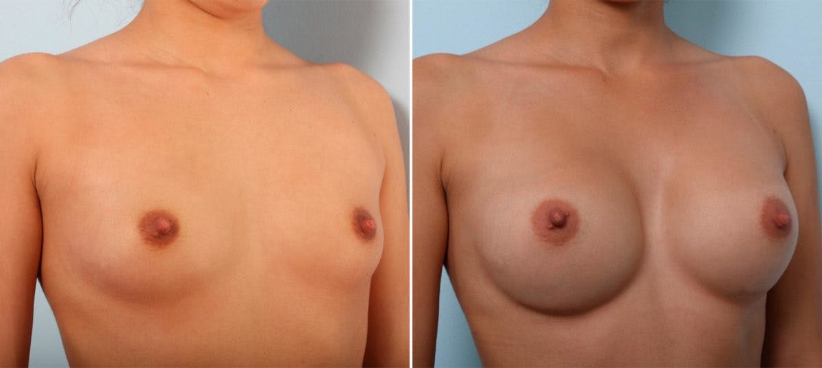 Breast Augmentation Before & After Gallery - Patient 54887247 - Image 2