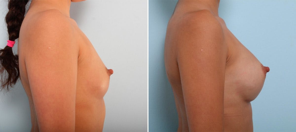 Breast Augmentation Before & After Gallery - Patient 54887247 - Image 3