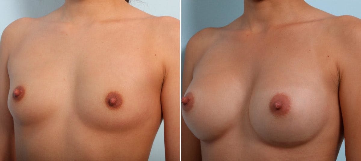 Breast Augmentation Before & After Gallery - Patient 54887247 - Image 4