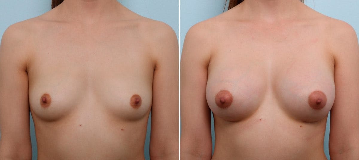 Breast Augmentation Before & After Gallery - Patient 54887249 - Image 1