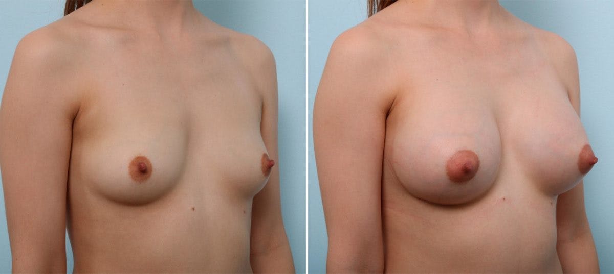 Breast Augmentation Before & After Gallery - Patient 54887249 - Image 2