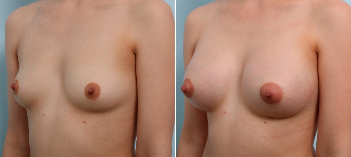 Breast Augmentation Before & After Gallery - Patient 54887249 - Image 4