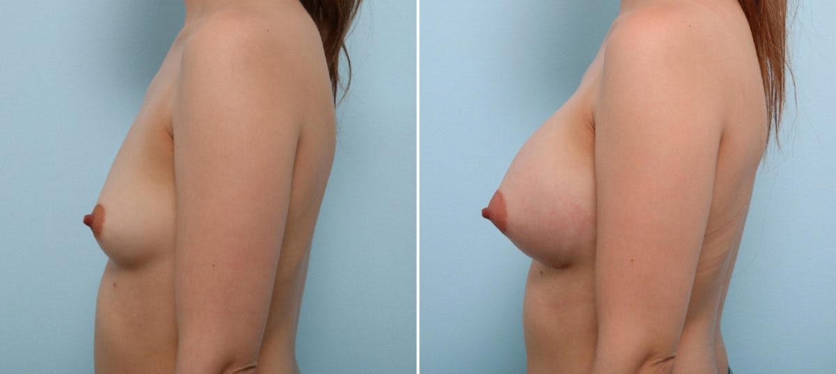 Breast Augmentation Before & After Gallery - Patient 54887249 - Image 5