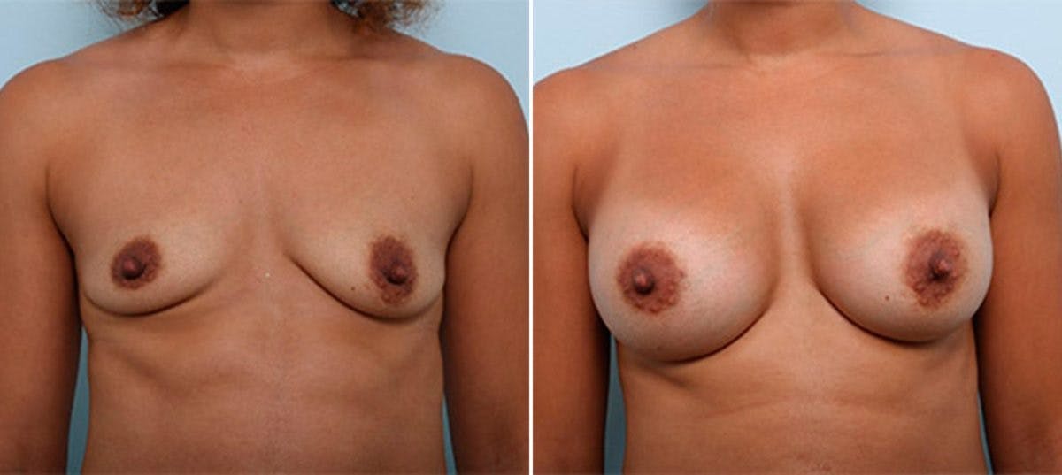 Breast Augmentation Before & After Gallery - Patient 54887250 - Image 1