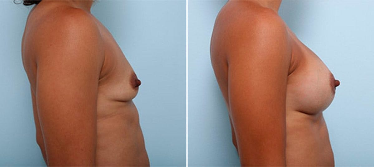 Breast Augmentation Before & After Gallery - Patient 54887250 - Image 2