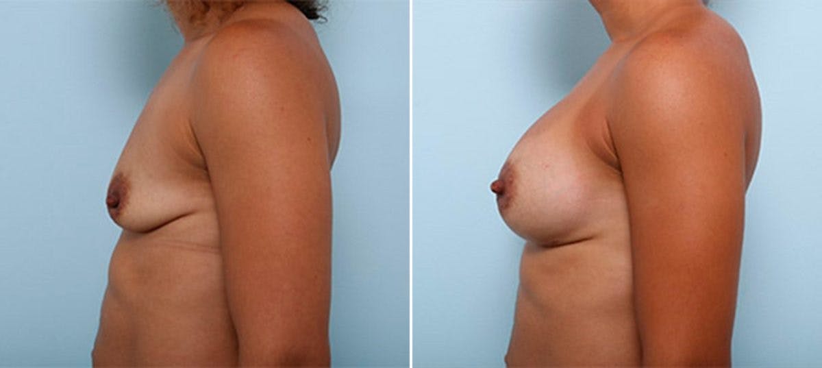 Breast Augmentation Before & After Gallery - Patient 54887250 - Image 4
