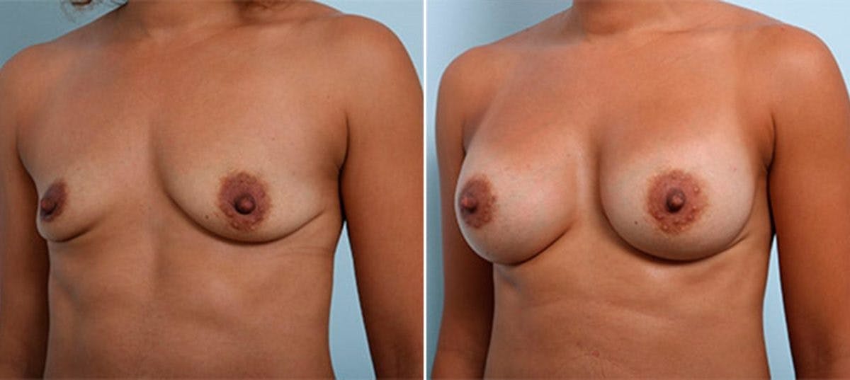 Breast Augmentation Before & After Gallery - Patient 54887250 - Image 5