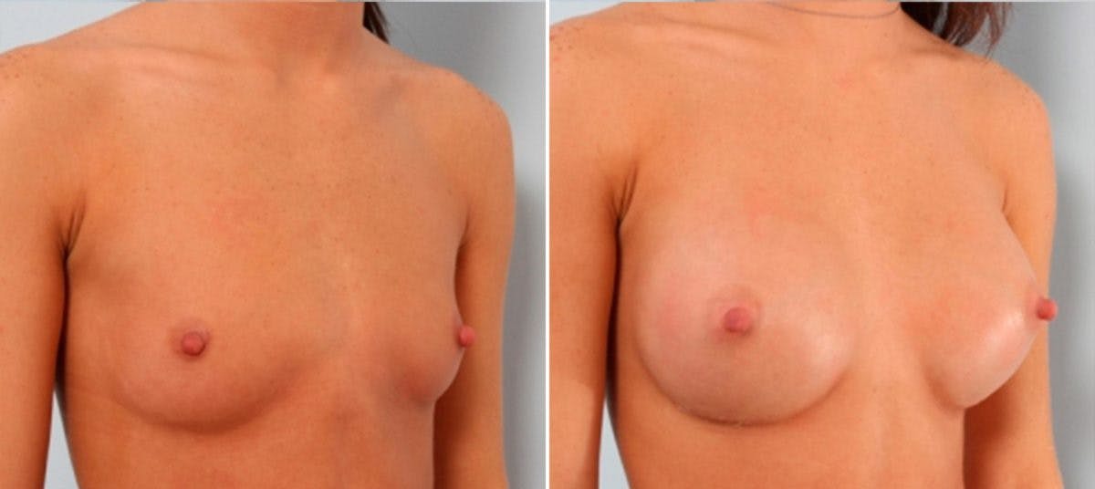 Breast Augmentation Before & After Gallery - Patient 54887253 - Image 2