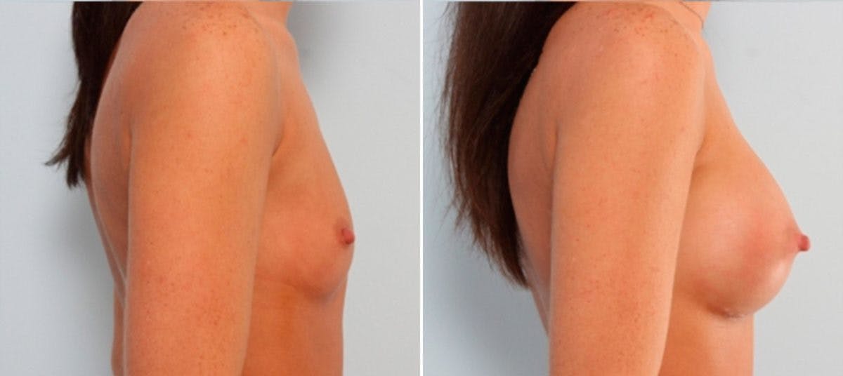 Breast Augmentation Before & After Gallery - Patient 54887253 - Image 3