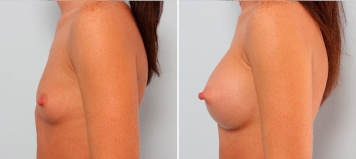 Breast Augmentation Before & After Gallery - Patient 54887253 - Image 5