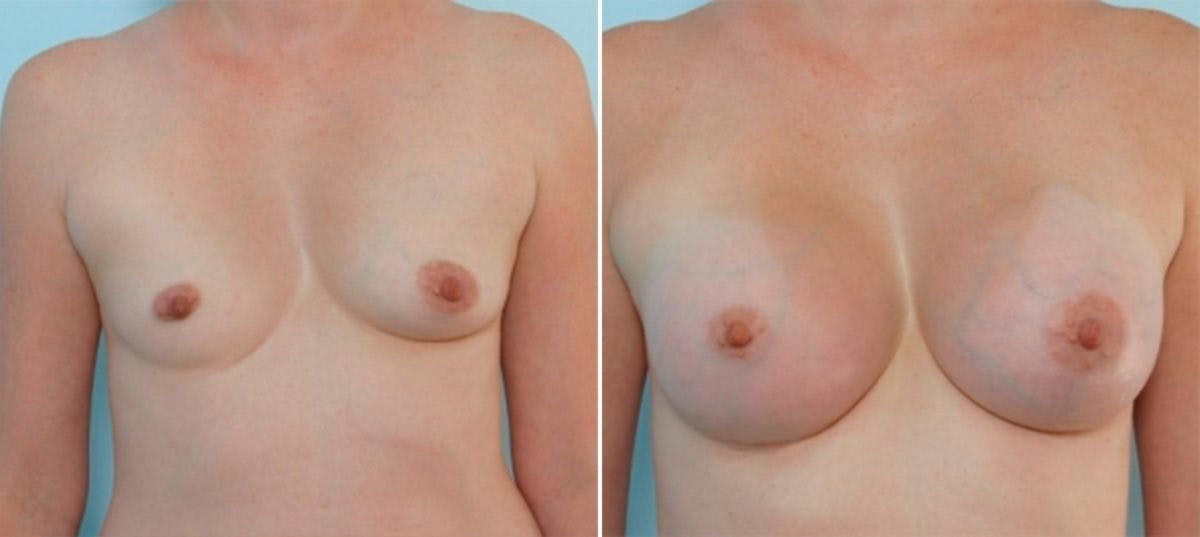 Breast Augmentation Before & After Gallery - Patient 54887256 - Image 1