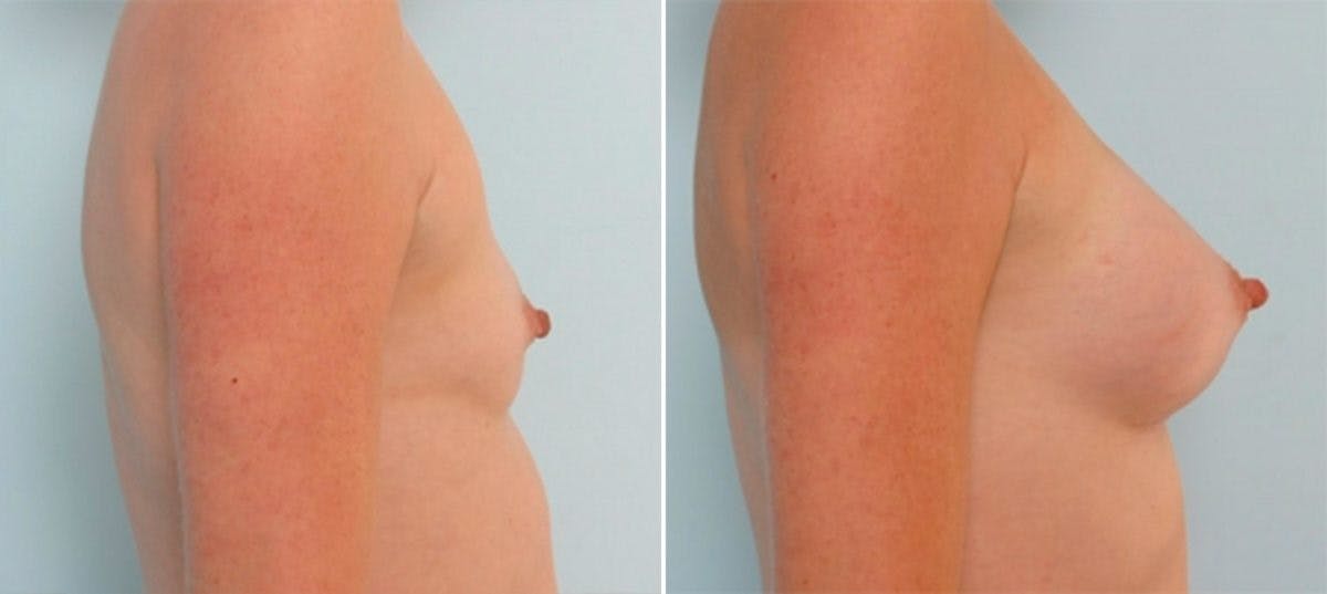 Breast Augmentation Before & After Gallery - Patient 54887256 - Image 3