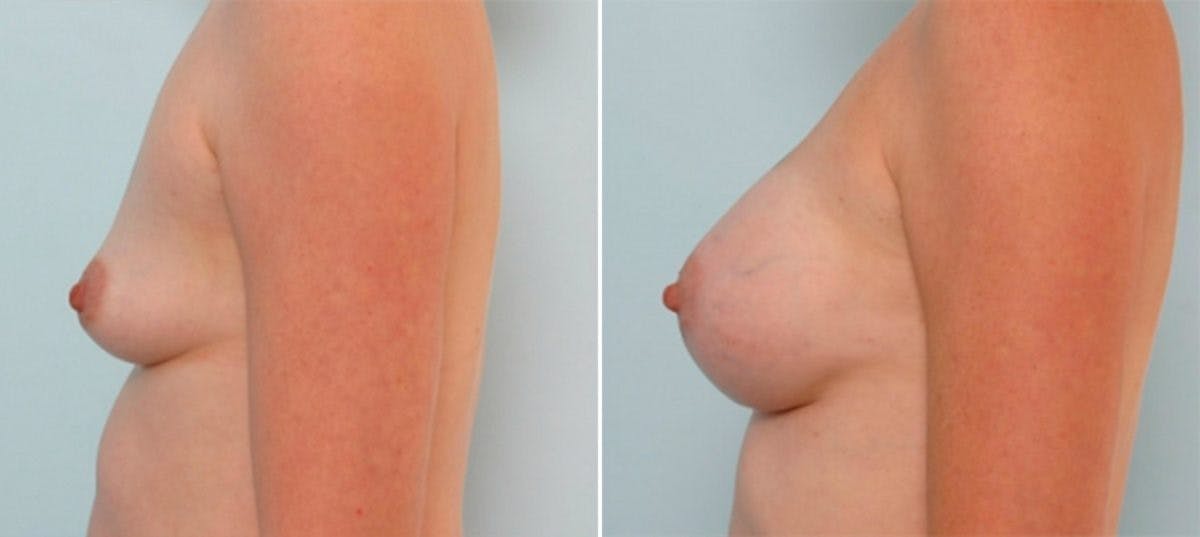 Breast Augmentation Before & After Gallery - Patient 54887256 - Image 4