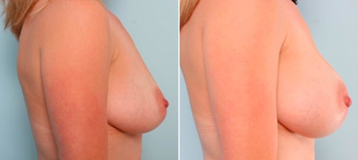 Breast Augmentation Before & After Gallery - Patient 54887257 - Image 3