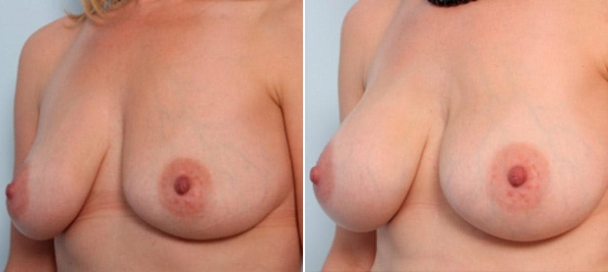 Breast Augmentation Before & After Gallery - Patient 54887257 - Image 4