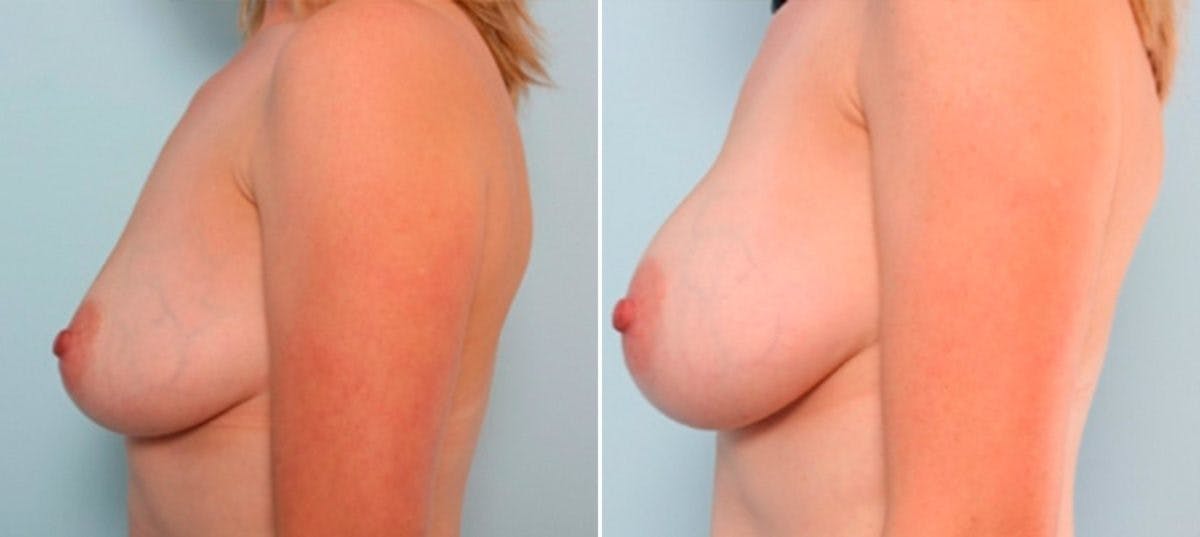 Breast Augmentation Before & After Gallery - Patient 54887257 - Image 5