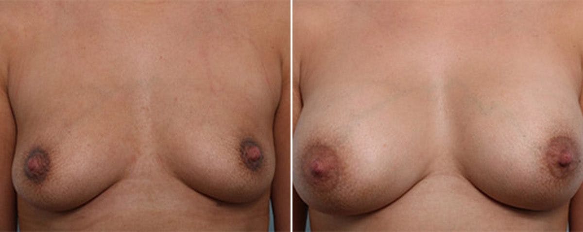 Breast Augmentation Before & After Gallery - Patient 54887259 - Image 1