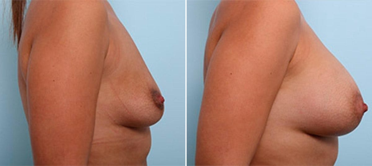 Breast Augmentation Before & After Gallery - Patient 54887259 - Image 3