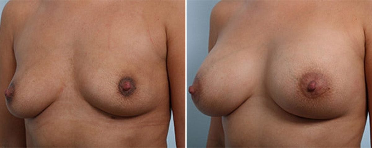 Breast Augmentation Before & After Gallery - Patient 54887259 - Image 4