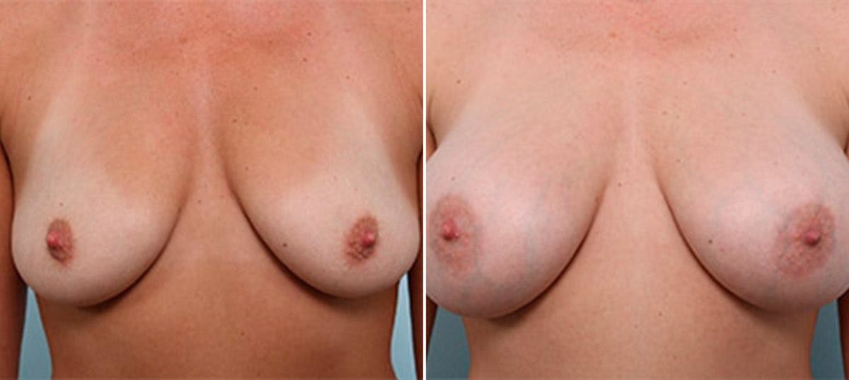 Breast Augmentation Before & After Gallery - Patient 54887262 - Image 1
