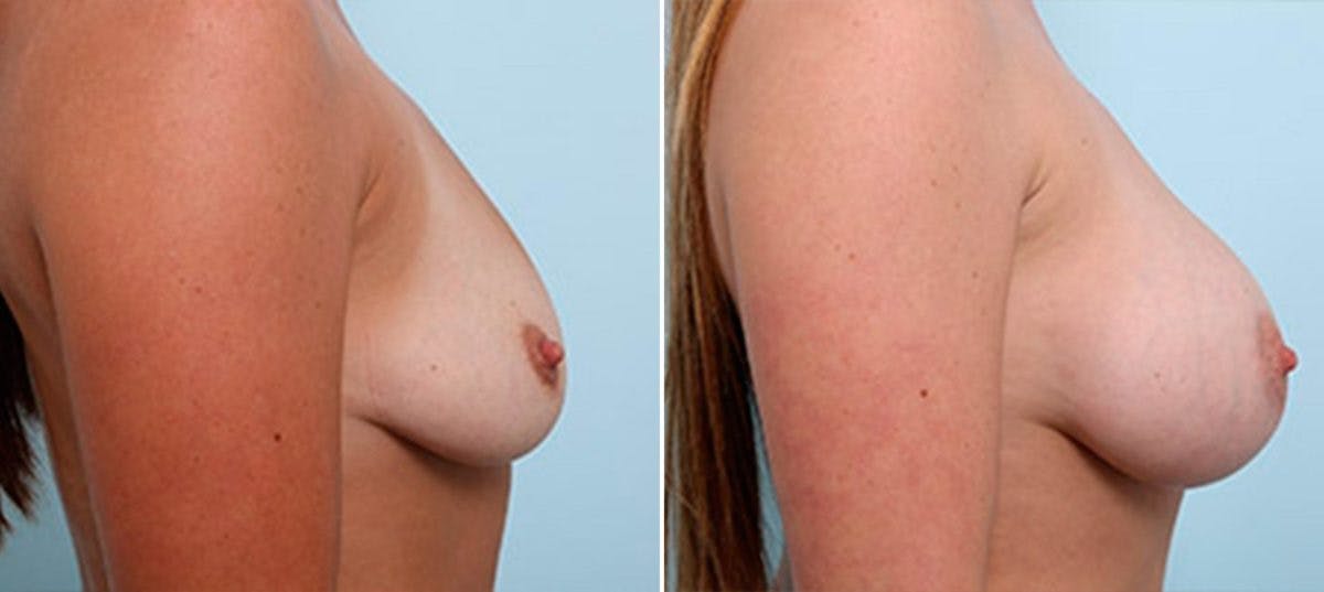 Breast Augmentation Before & After Gallery - Patient 54887262 - Image 3