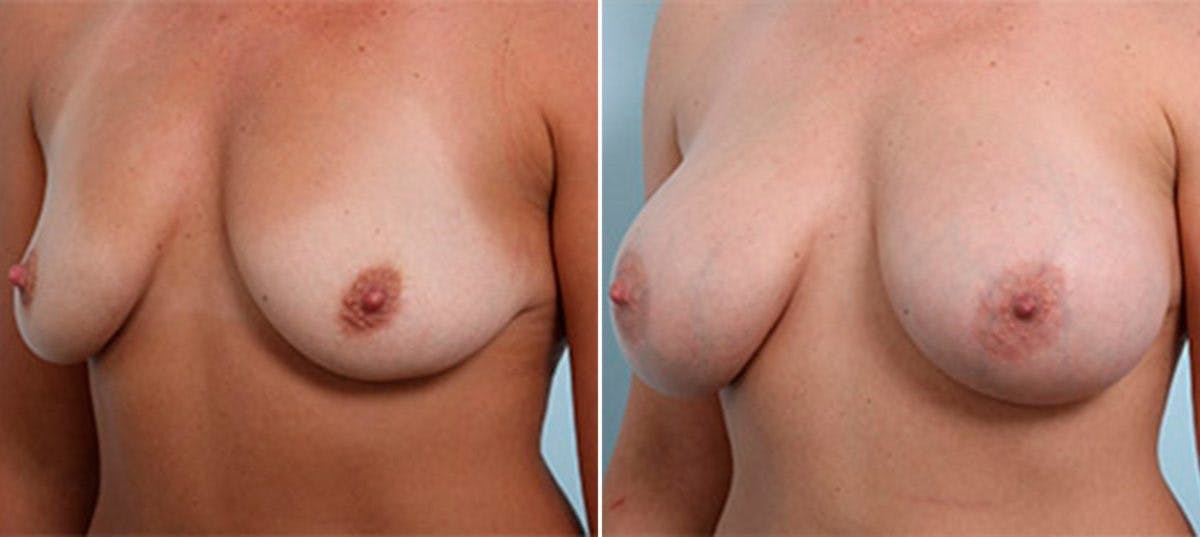 Breast Augmentation Before & After Gallery - Patient 54887262 - Image 4