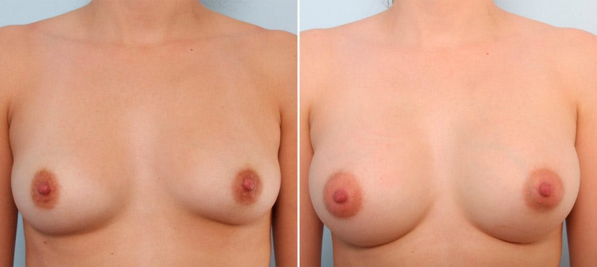 Breast Augmentation Before & After Gallery - Patient 54887263 - Image 1