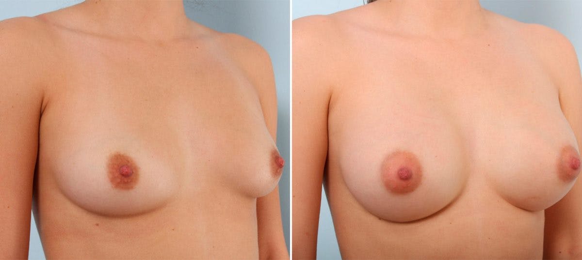 Breast Augmentation Before & After Gallery - Patient 54887263 - Image 2