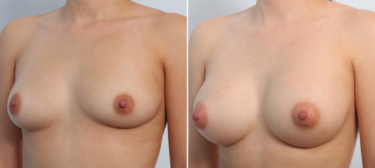 Breast Augmentation Before & After Gallery - Patient 54887263 - Image 4
