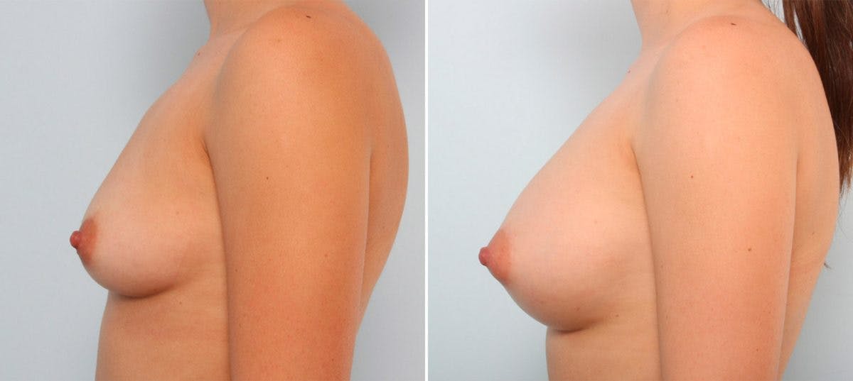 Breast Augmentation Before & After Gallery - Patient 54887263 - Image 5