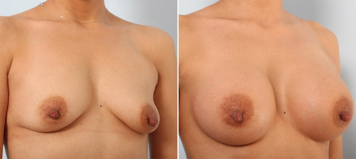 Breast Augmentation Before & After Gallery - Patient 54887265 - Image 2