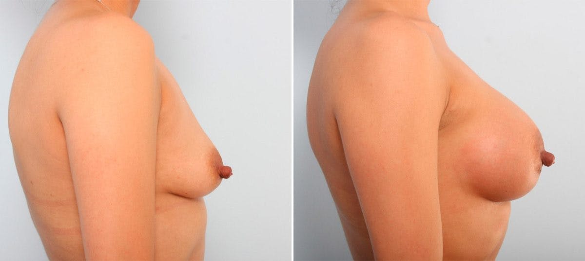 Breast Augmentation Before & After Gallery - Patient 54887265 - Image 3