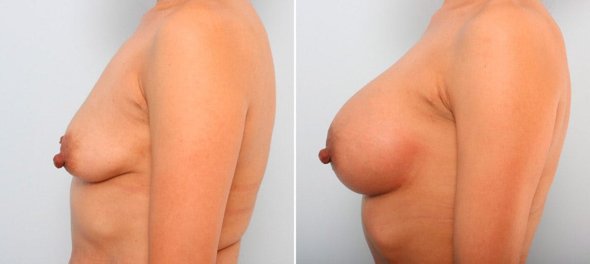 Breast Augmentation Before & After Gallery - Patient 54887265 - Image 4