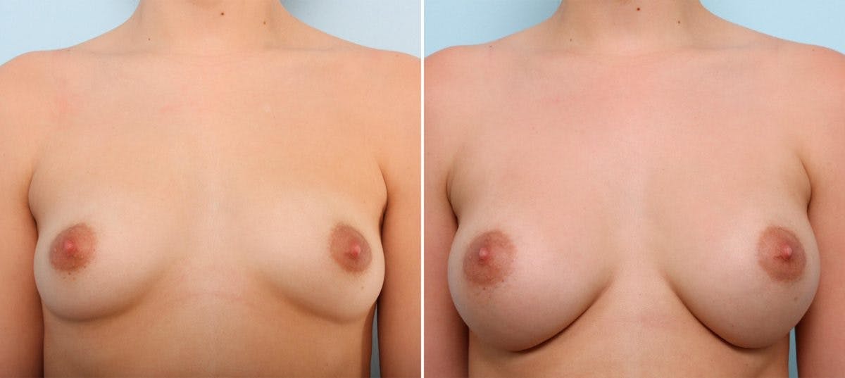 Breast Augmentation Before & After Gallery - Patient 54887266 - Image 1